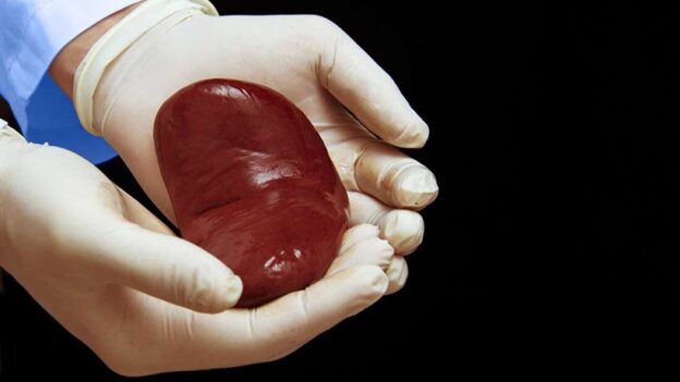 Successful Pig to Human Kidney Transplant
